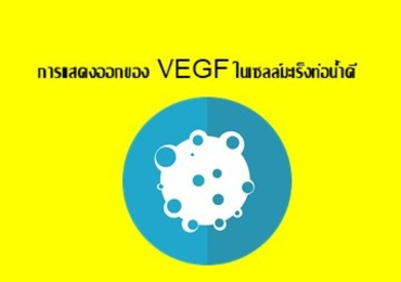 การแสดงออกของ VEGF ในเซลล์มะเร็งท่อน้ำดี