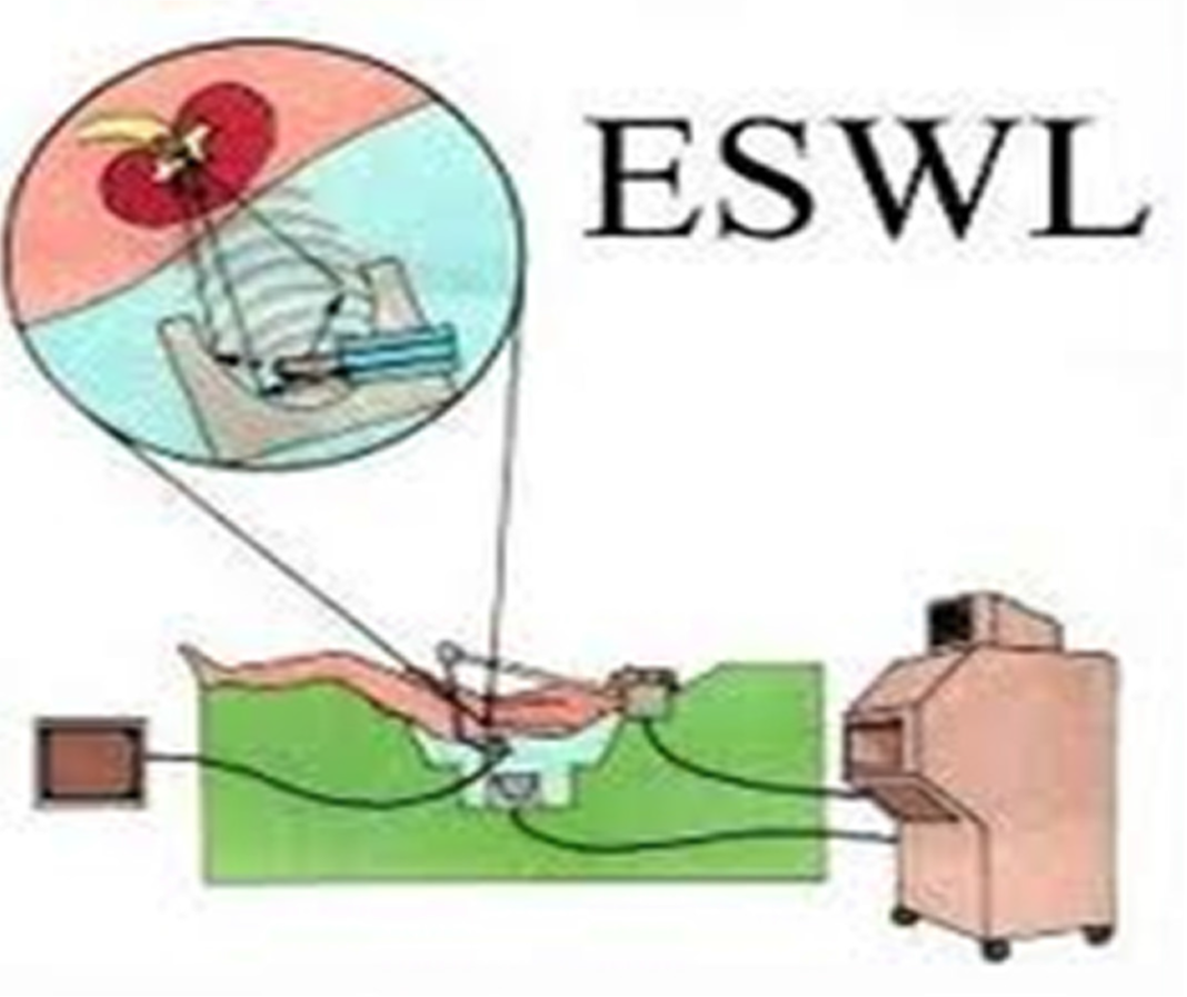 เครื่องสลายนิ่ว (ESWL)