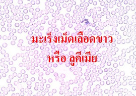 มะเร็งเม็ดเลือดขาว หรือ ลูคีเมีย พารามิเตอร์รูปภาพ 1