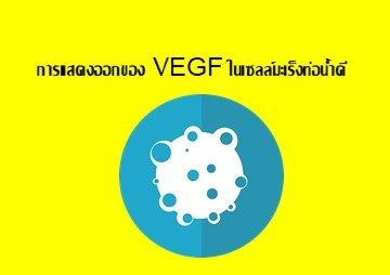 การแสดงออกของ VEGF ในเซลล์มะเร็งท่อน้ำดี รูปภาพ 1