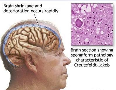 การทำงานของเชื้อไวรัสวัวบ้า (BSE) เวลาอยู่ในสมองมนุษย์